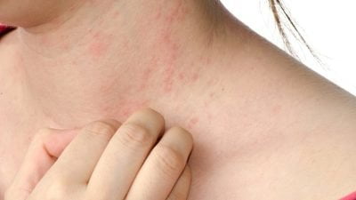 Açık alanlardan besin alırken dikkat, uzmanlar uyarıyor: "Besin alerjilerinde kazara