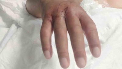 HATAY’DA NARENCİYE HASADI YAPTIĞI ESNADA YILAN SOKAN ÇİFTÇİ TEDAVİ ALTINA