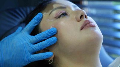 KAŞIN, GÖZ KENARININ VE ELMACIK KEMİĞİ BÖLGESİNİN YUKARIYA DOĞRU KALDIRILMASIYLA