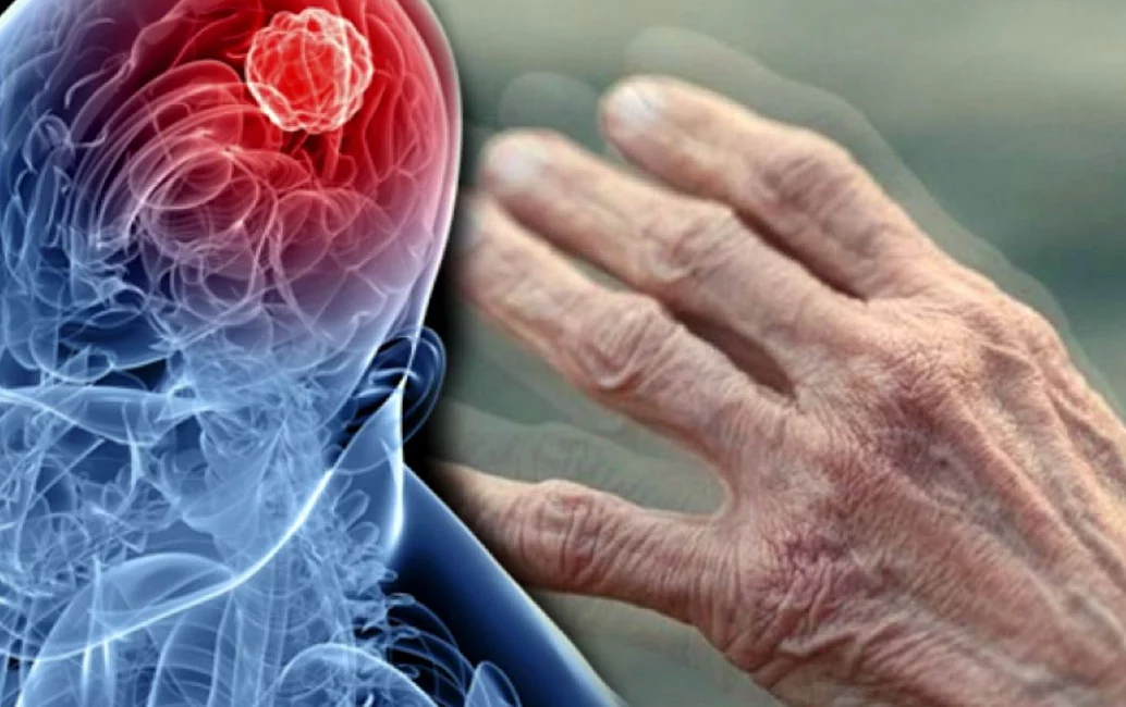 Nöroloji Uzmanı Prof. Dr. Sultan Tarlacı, Parkinson hastalığındaki artışın yalnızca